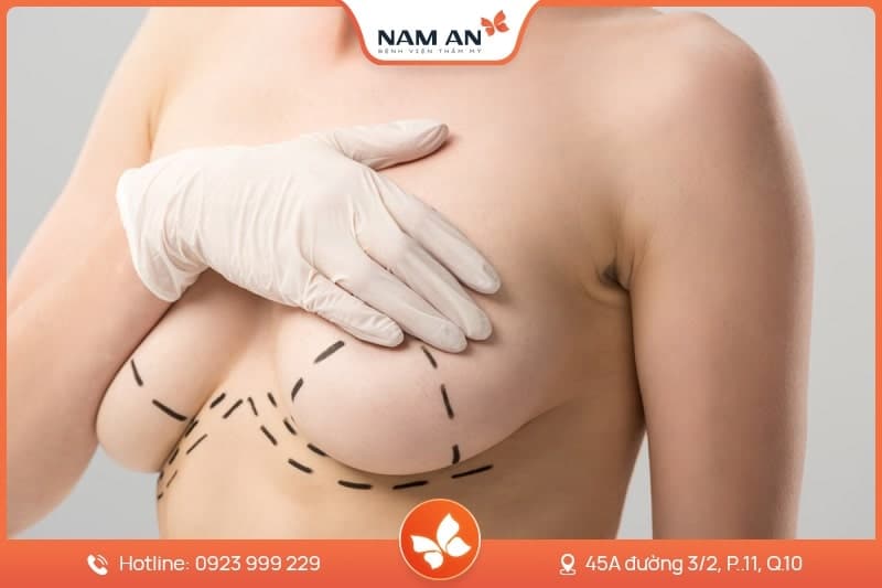 Phẫu Thuật Treo Ngực Sa Trễ - Lấy Lại Vòng 1 Săn Chắc (6)