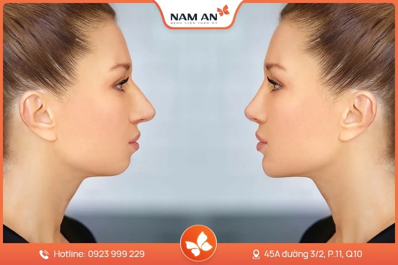 Phẫu Thuật Trượt Cằm Tự Thân Đẹp Tự Nhiên Tại Nam An (4)