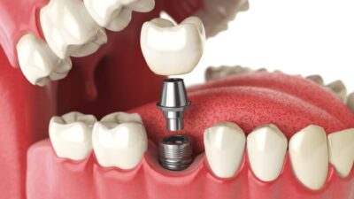 Sau Khi Nhổ Răng Bao Lâu Thì Cấy Ghép Implant Được?