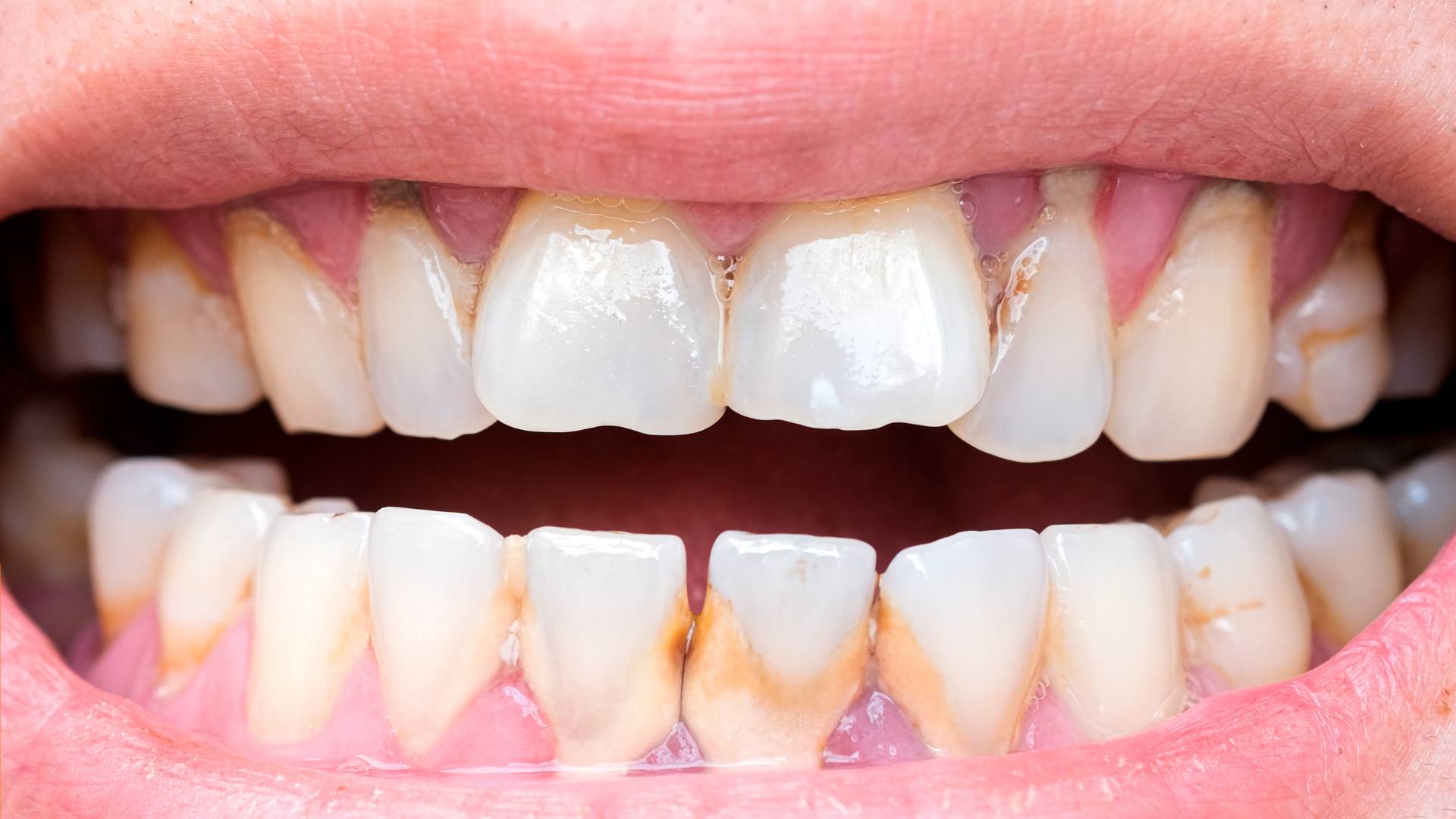 Tác Hại Của Việc Không Cạo Vôi Răng Dẫn Đến Viêm Nha Chu