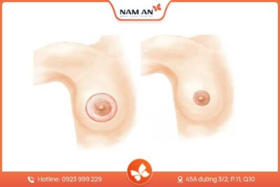 Thu Gọn Quầng Vú Tỉ Lệ Vàng, Không Lộ Sẹo Tại Nam An