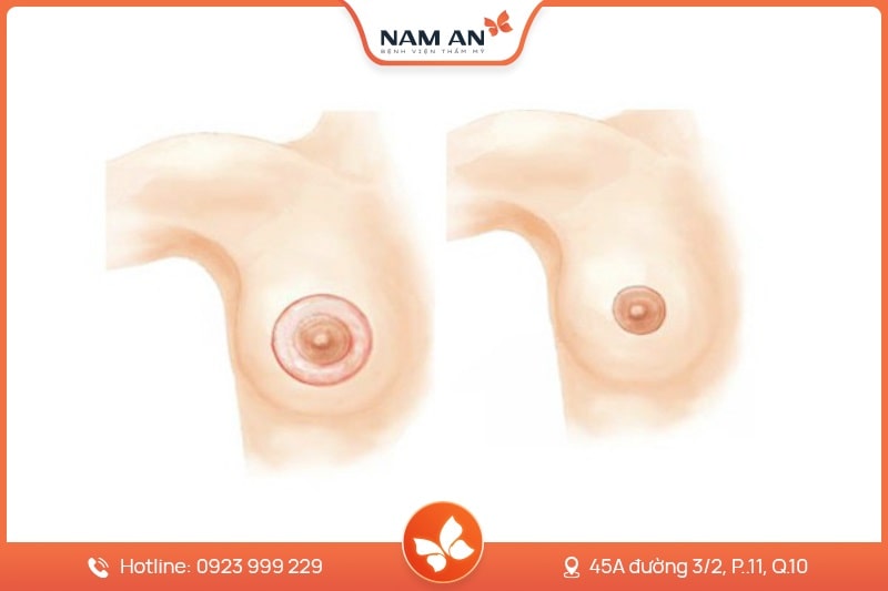 Thu Gọn Quầng Vú Tỉ Lệ Vàng, Không Lộ Sẹo Tại Nam An (9)
