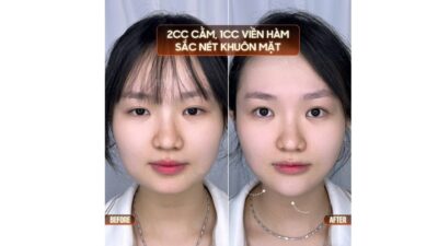 Tiêm Filler Có An Toàn Không? Vì Sao Lại Được Ưa Chuộng?
