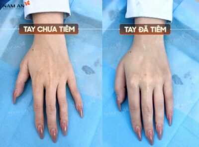 Bí Quyết Điều Trị Lão Hóa Da Tay Chuẩn Khoa Học Tại Nam An