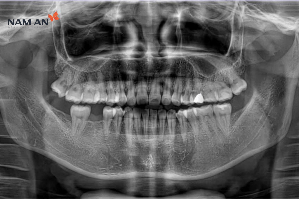 Trồng Răng Implant Mất Bao Lâu Yếu Tố Ảnh Hưởng (3)