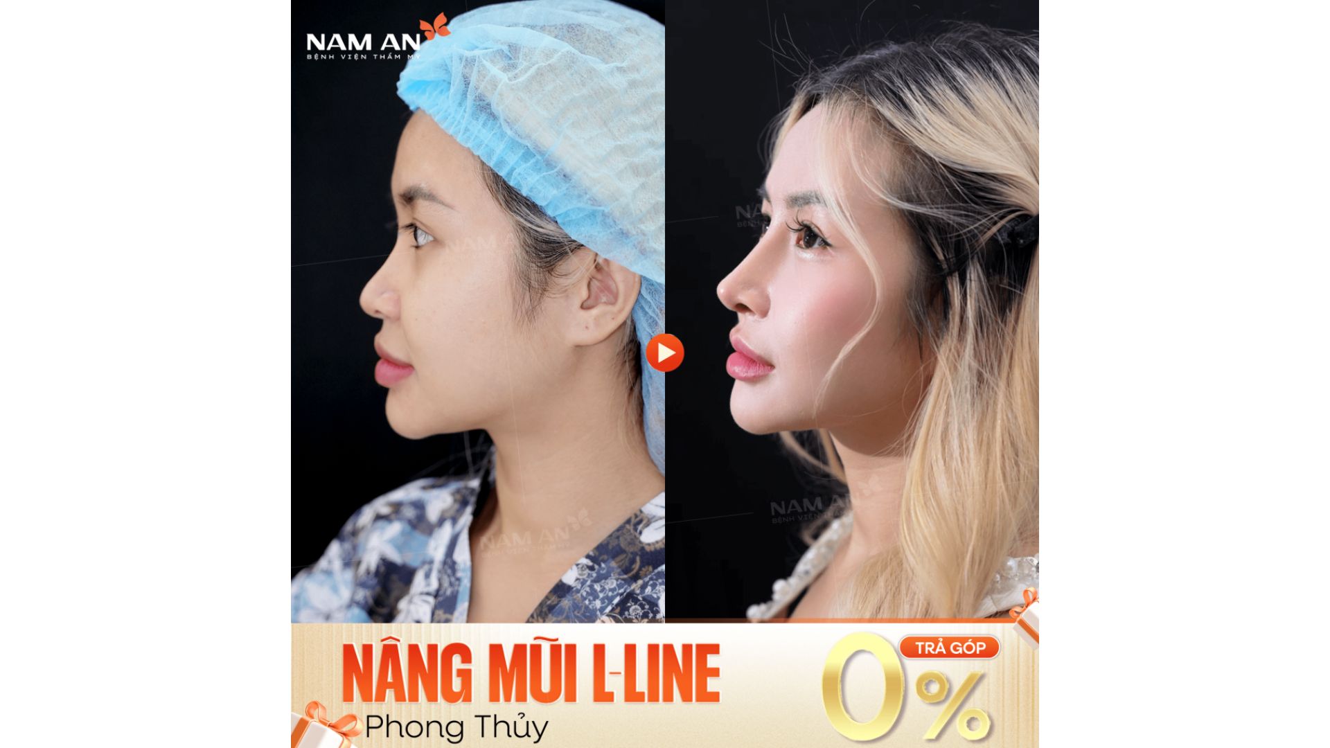 Xu Hướng Nâng Mũi Tự Nhiên Và An Toàn Tại Nam An (7)